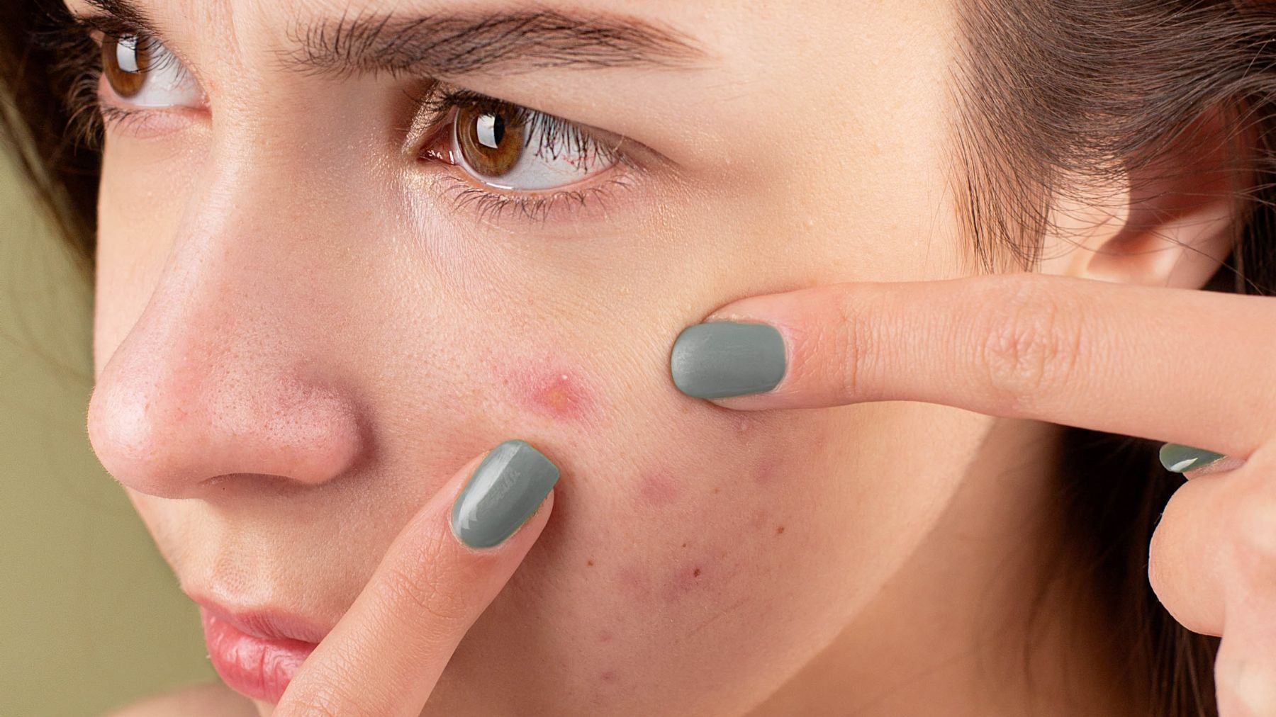 Pimples on your face: what they reveal about your health